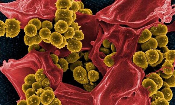 Золотистый стафилококк как причина бактериального простатита